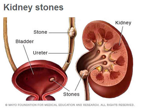 Kidney-Stones