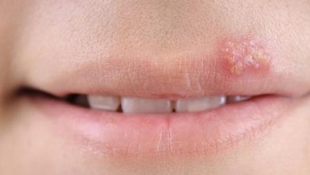 Mouth watering blisters can be #Herpes! Know what happens…
