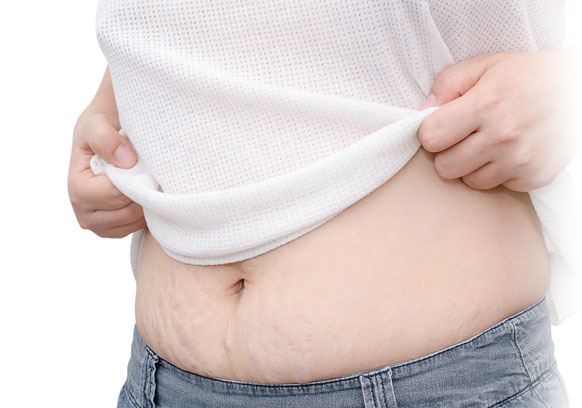 #BEAUTY: Want to get rid of stretch marks, they are useful ...