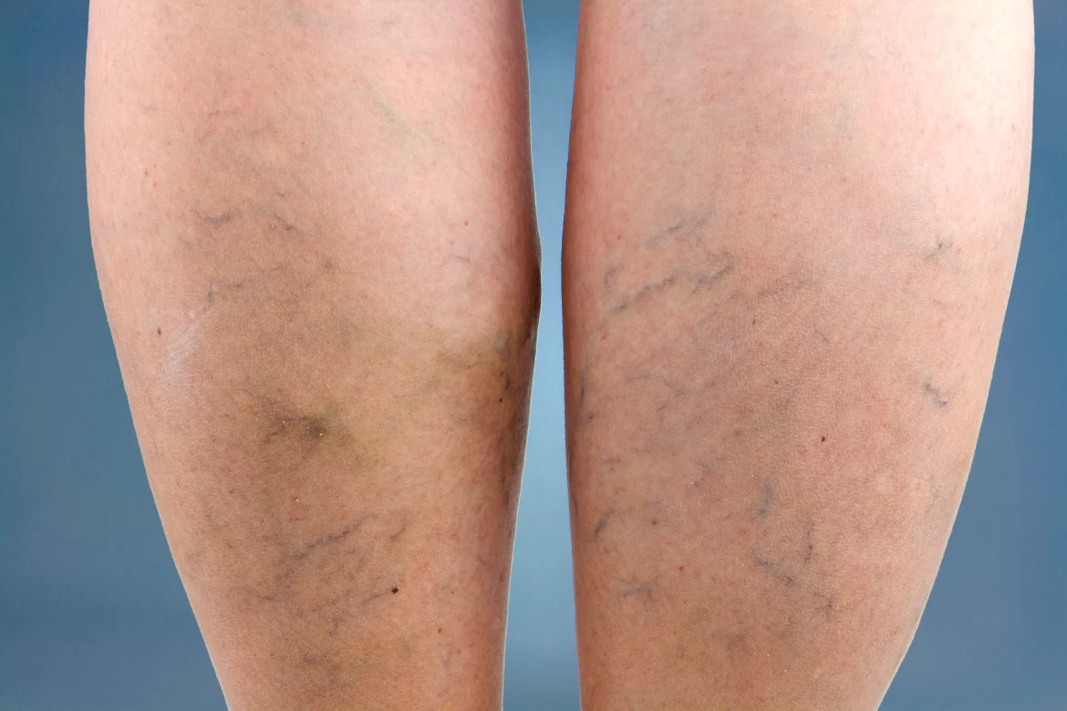 Spider Veins on Feet